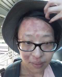 Photo of Catherine with red patches all over her face