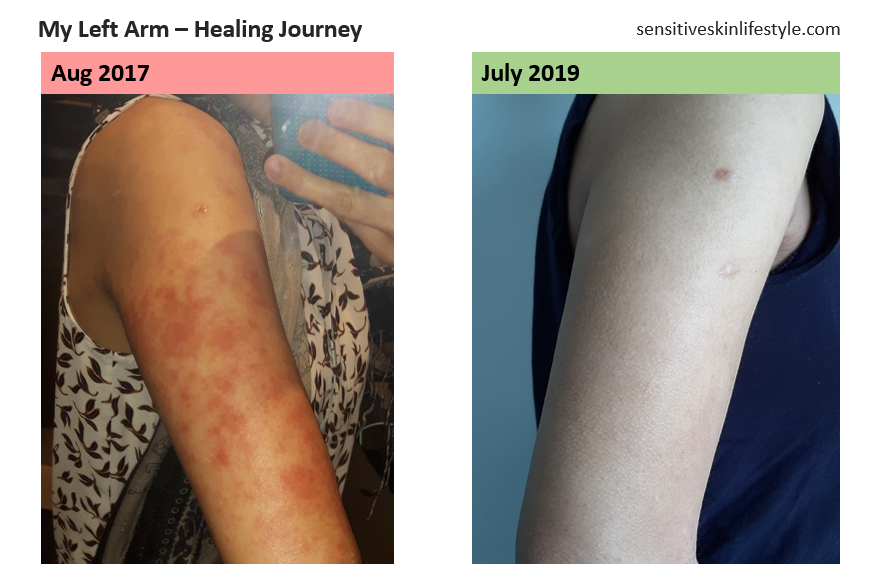 My Left Arm's Progress - August 2017 vs July 2019