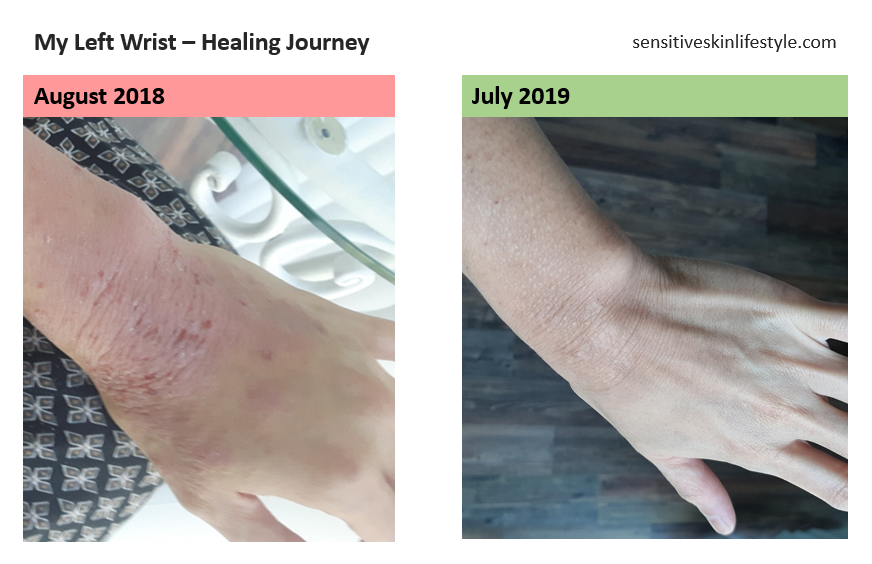 My Right Wrist's Progress:  August 2018 vs July 2019