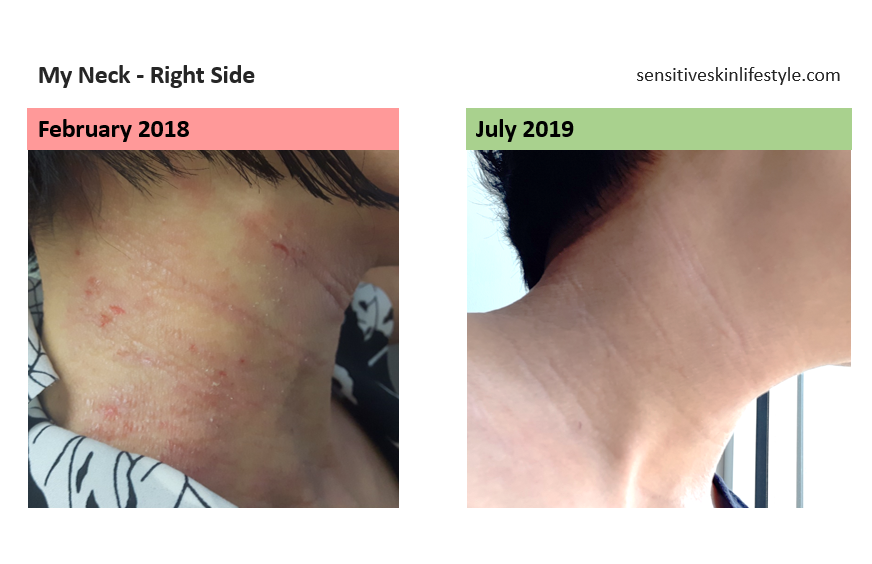 The Right Side of My Neck - Progress Photos February 2018 vs July 2019